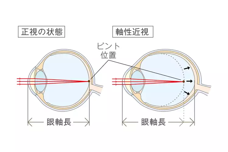 正視の状態と軸性近視のイラスト